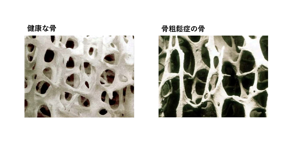 骨粗鬆症イメージ2