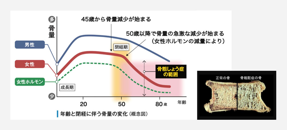 骨粗鬆症イメージ4