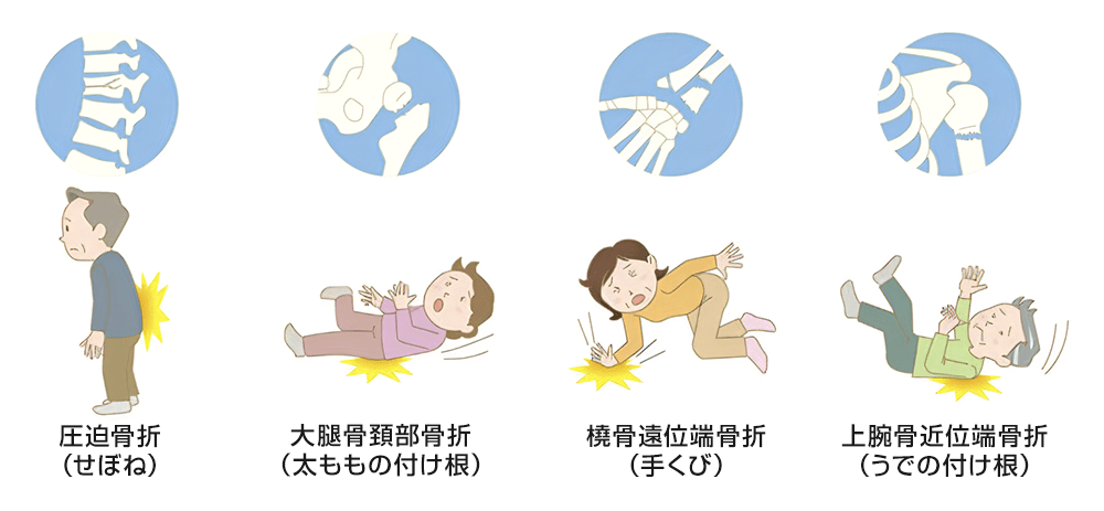 骨粗鬆症イメージ7
