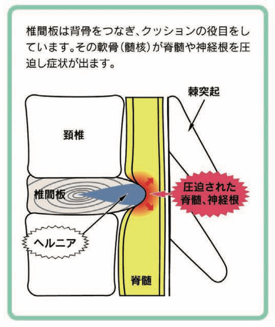 頚椎椎間板ヘルニアイメージ1