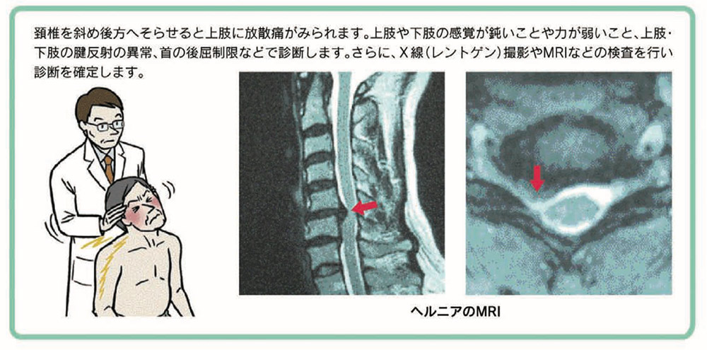 頚椎椎間板ヘルニアイメージ2