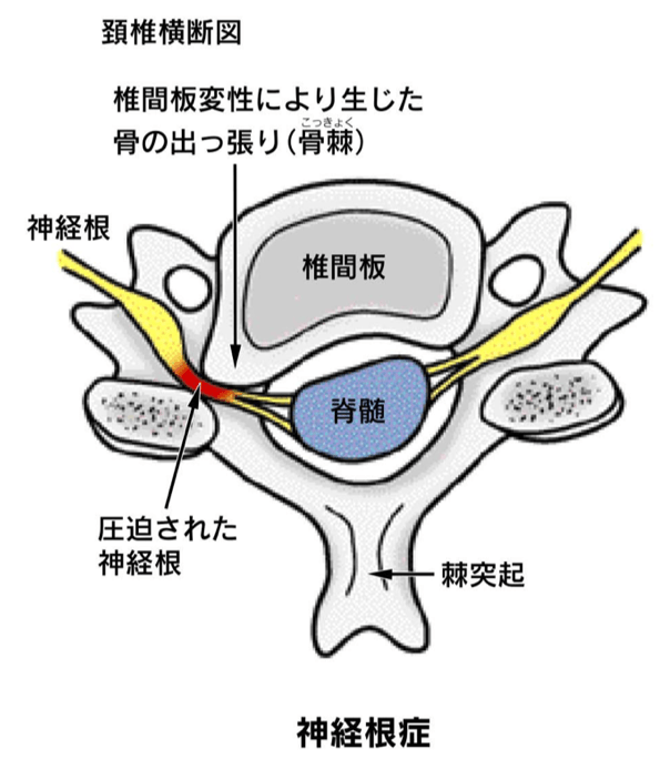 頚椎症性神経根症イメージ
