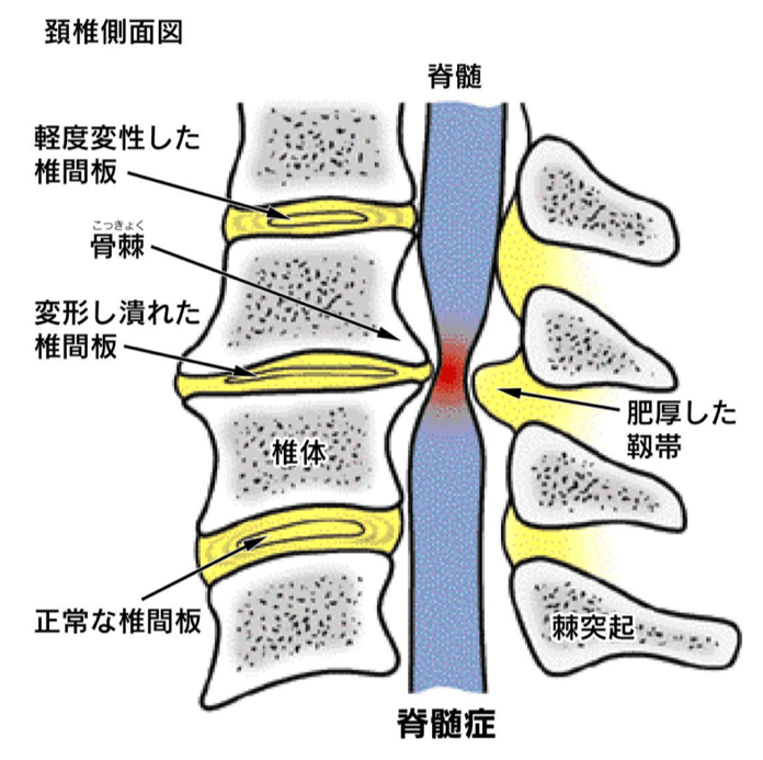 頚椎症性脊髄症イメージ