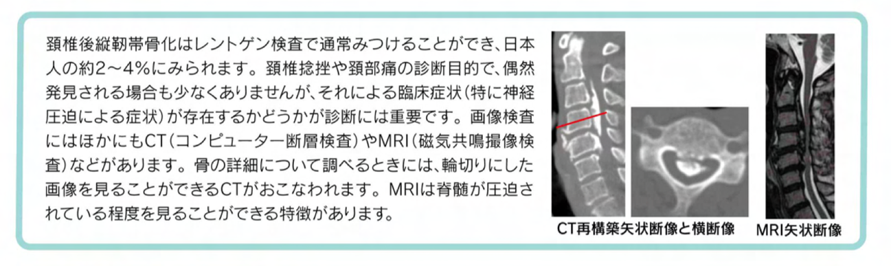 頚椎後縦靭帯骨化症イメージ2